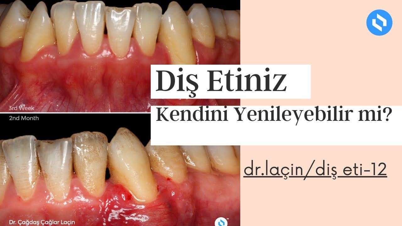 Diş Eti Kendini Onarabilir mi? — kapak görseli